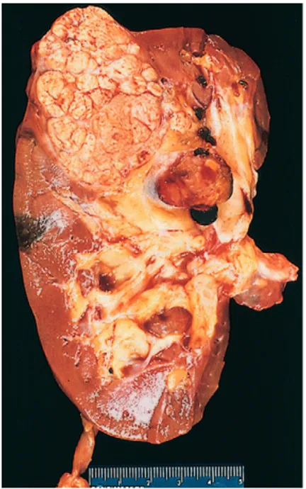 Figure  13–23   Renal  cell  carcinoma:  Representative  cross-section  showing yellowish, spherical neoplasm in one pole of the kidney