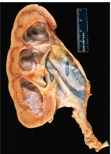 Figure  13–22   Hydronephrosis of the kidney, with marked dilation of  the pelvis and calyces and thinning of renal parenchyma