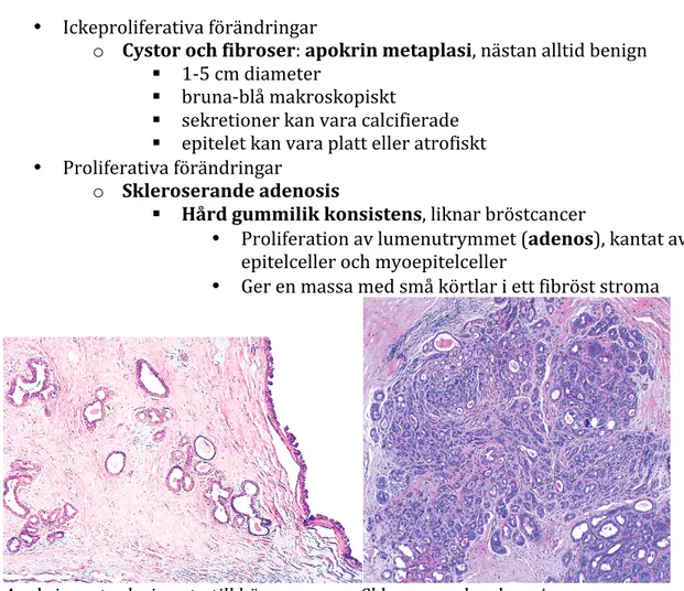 Figure  18–25   Epithelial  hyperplasia  in  a  breast  biopsy  specimen.  The  duct lumen is filled with a heterogeneous population of cells of differing  morphology