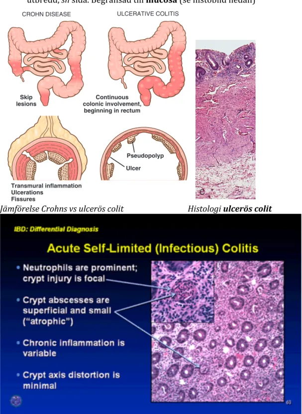 Figure  14–26   Distribution  of  lesions  in  inflammatory  bowel  disease.  The  distinction  between  Crohn  disease  and  ulcerative  colitis  is  based  primarily on morphology