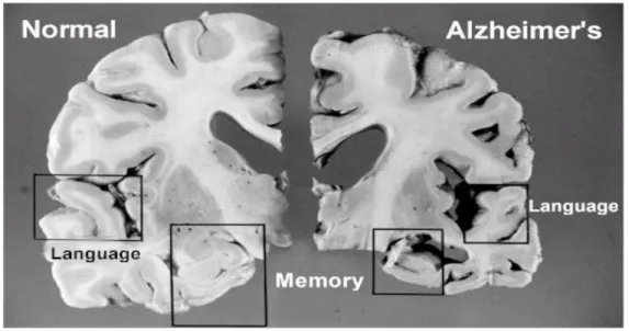 Figur 1. Illustration av hjärnan angripen av Alzheimers demens.