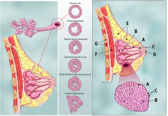 Figur 1. Bröstcancer (cancer mammae) och dess utveckling. De två vanligaste  varianterna av bröstcancer: t.v