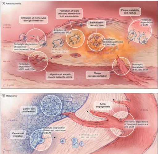 Figure 2A and 2B. Cathepsin S in the progression of atherosclerosis and malig- malig-nancy