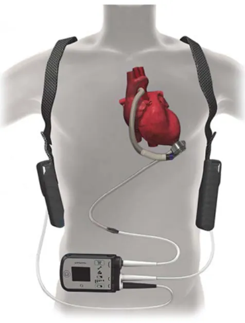 Figur 1. HeartMate 3 Left Ventricular Assist System [11]. 