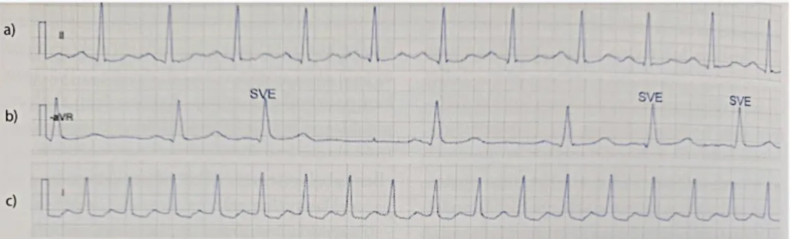 Figur 3. Exempel på EKG-registrering som visar olika arytmier. I a) sinustakykardi, b)  supraventrikulära extraslag (SVES), c) paroxysmal supraventrikulär takykardi (PSVT) [4]