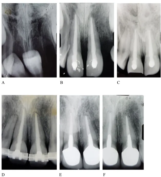 Fig. 1. 10-year-old girl with avulsion of the two central incisors. A. The roots were displaced  out of the alveolar socket but remained attached to the palatal gingiva