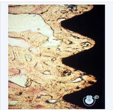 Figure 3  According to an old definition, Osseointegration represents a direct  (at the light microscopical level of resolution) between bone and implant.