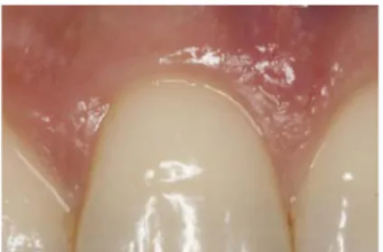 Figure 3. Probed latera incisor with masking  Figure 4. Unprobed central incisor including  adjacent papillae, without masking 