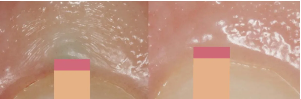 Figure 6. Crease formation of the gingival tissue during probing in the left picture compared to the absence of the probe in  the right picture