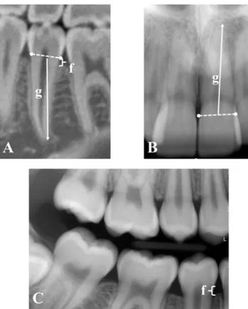 Figure 1  Cross-sectional CBCT image (A), periapical (B), and bite- bite-wing (C) images used for measurement of root length (g) and marginal  bone level (f).