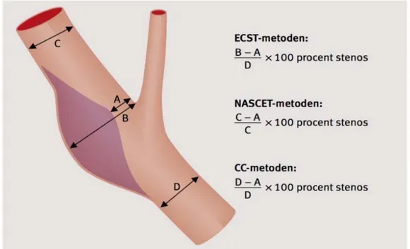 Figur 1. Visar upp de tre olika bedömningsmetoderna ECST, NASCET och CC-metoden  för stenosgradering i a