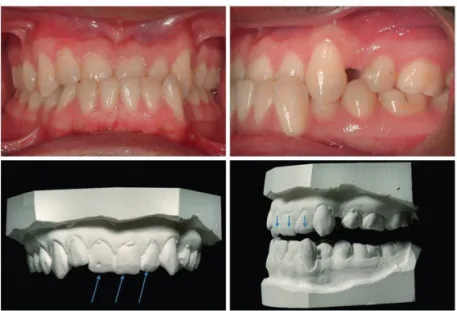 Figure  1.  Abrasion of the enamel on the labioincisal edges of 11, 21, 22.  These teeth had previously been in anterior crossbite with functional shift.