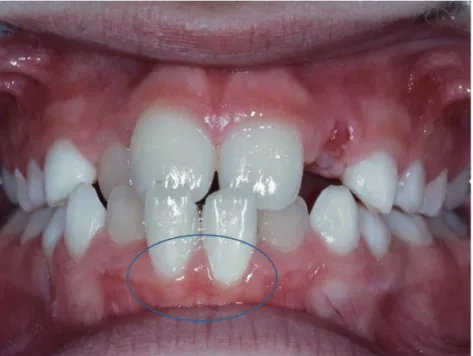 Figure 2.  Initial gingival recession 31,41.