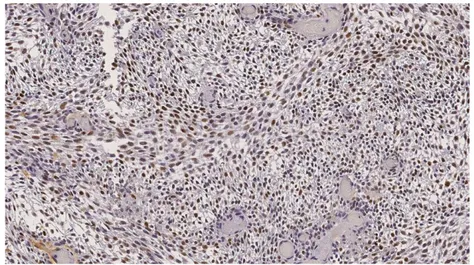Figure 7. Ameloblastoma: p53 staining illustrating value 4, Fully positively stained.   Corresponding staining values were used for Ki-67