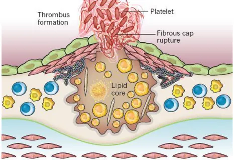 Figur 2 Formationen av ostabilt plack genom att det skapas en  nekrotisk kärna. (9)(s.318) 