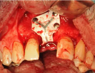 Figure 3.  Guided bone regeneration using e-PTFE membrane