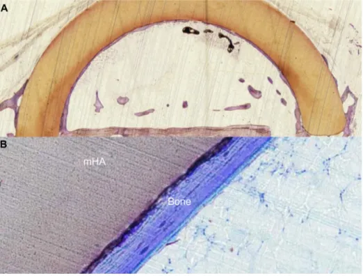 Figure 6 Volume of newly formed bone inside the hydroxyapatite space-maintaining device (A) and histological interface between new bone and microporous hydroxyapatite  (mha) (B).