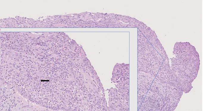 Figur 5. Prov 4. Jätteceller (pil) av M1-makrofager (CD68+). Figur 4. Prov 1. Neutrofiler (pil) som infiltrerat epitelet