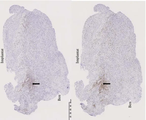 Figur 8. Prov 1. Vänster bild: T-celler (CD3+) (se pil). Höger bild: B-celler (CD20+) (se pil)