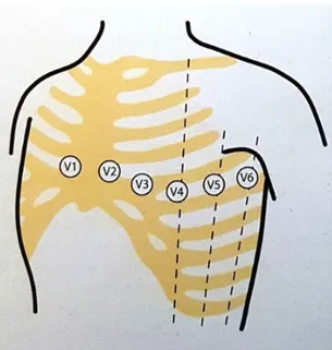 Figur 2: Figuren visar placering av prekordialelektroder. V1 och V2 placeras i  fjärde interkostalrummet på höger respektive vänster sida av bröstbenet
