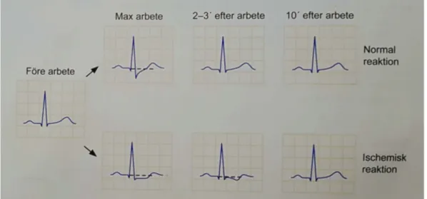 Figur 4: Figuren visar skillnaden mellan en normal och en ischemisk EKG- EKG-reaktion under arbete