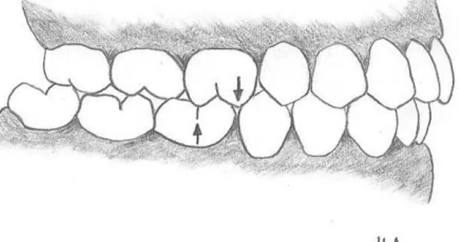 Figur 1. Angle klass II - där mandibelns första molar biter en kuspbredd distalt om maxillans första molar