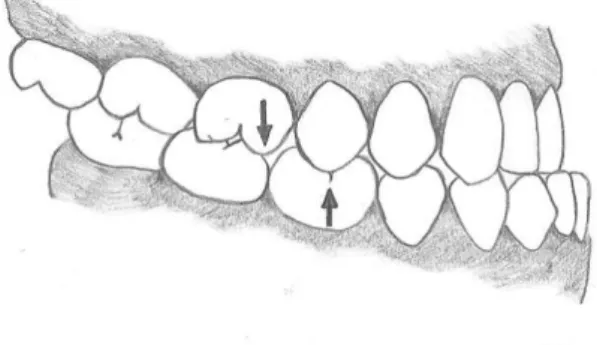 Figur 2. Angle III – där mandibelns första molar biter en kuspbredd mesialt om maxillans första molar
