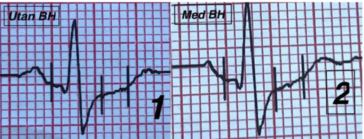 Figur 5 . EKG-komplex i V5 från en deltagares resultat vid maxbelastning där EKG:et  visuellt bedömdes ha bättre kvalité vid användning av sport–BH än utan sport-BH