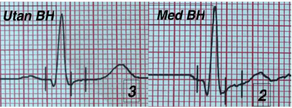 Figur 6.  EKG-komplex i V5 från en deltagares resultat vid maxbelastning där EKG:et  visuellt bedömdes ha bättre kvalité utan sport–BH än vid användning av sport-BH