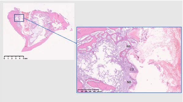 Figure 8. Histological analysis of Ti (10 days). NB: New bone; CO: Contact osteogenesis