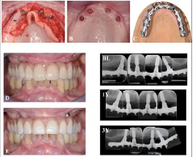 Figure 13. Figures of a patient belong to the 4-implant group with x-rays  at Baseline (BL), 1-year (1Y) and 3-year (3Y)