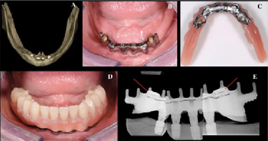 Figure 15. Clinical case of Study IV with 4 implants in position in the  mandible (A)