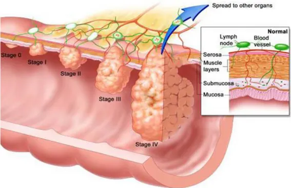 Figur 1: Schematisk bild över utveckling och vandring av tumörcellerna samt  olika stadier av tumörcellerna i kolon [7] 