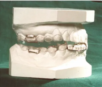 Figure 1 The oral appliances used in this study were manufactured in one-piece  heat-cured acrylic polymer.