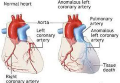 Figur 1.  Till vänster normalt hjärta där båda koronarkärlen utgår från aortan jämfört med  ett hjärta med ALCAPA där retrograd flöde uppstått i LCA, till höger  [7]