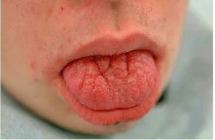 Figure 1. Tongue diastasis  Photo: Gunilla Klingberg 