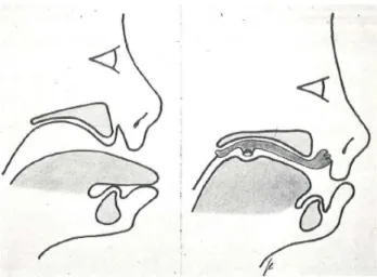 Figure 3a. Schematic  picture of a child with  hypotonic orofacial  muscles and a protruded  tongue without 