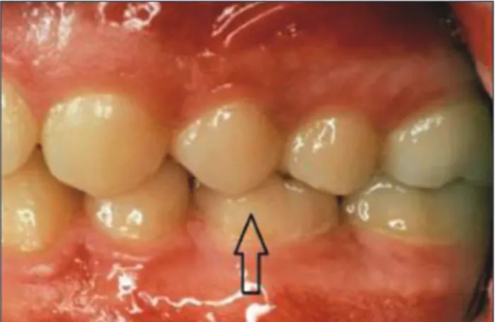 Figure 1: Maxillary third molar transplanted to the region of the  second premolar.