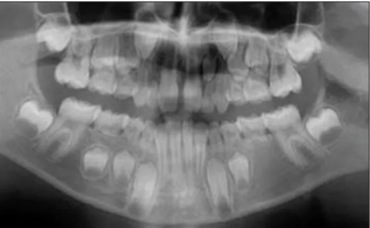 Figure 2: A 10-year-old boy with agenesis mandibular left second  premolar. Note the severely resorbed primary molars.