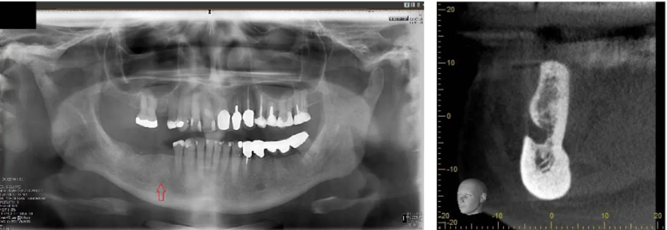 Figur 1 Exempel på CBCT- och Panoramabilder