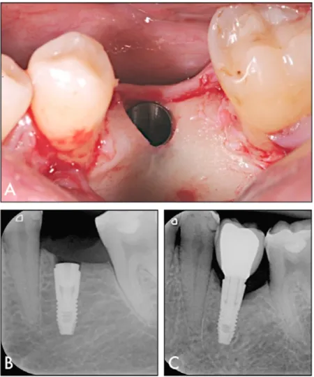 Figure 7.  The occurrence of early marginal bone resorption possibly  due to surgical trauma