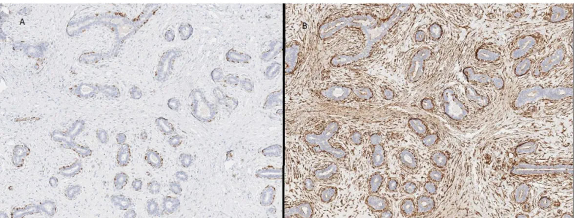 Figur 7: Vävnad från klots 2 nummer 4 färgad med SMMS-1 (A) respektive  caldesmon (B)