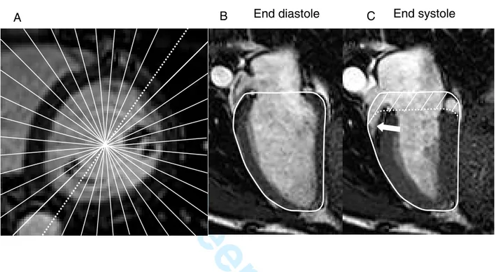 Figure 1. Radial projections of the left ventricle.  A. A short-axis MR image of the LV in end  diastole