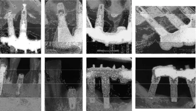 Figure 3. Examples of cases of severe marginal bone loss around implants that were eventually lost or  fractured