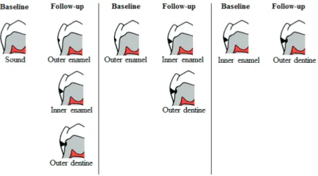 Figure 6. Modified classification system for assessment of caries lesion  progression of approximal surfaces in bitewing radiography (full  version presented in study II).