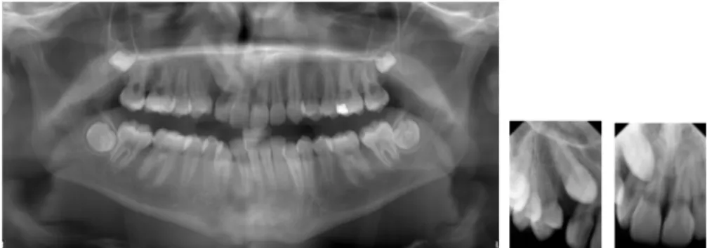 Figure 2. Panoramic and two periapical intraoral radiographs (Patient  case 2 in Study IV)