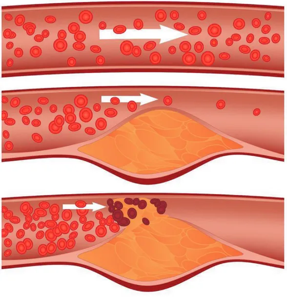 Figure 1.  Atherosclerosis causes narrowing of the coronary arteries, which can lead to angina  and eventually a myocordial infarction.