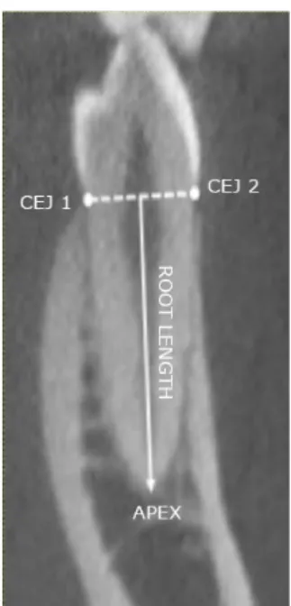 Figure 6. Example of conducted root length measurement in CBCT-images. A hypothetical line was drawn  between the CEJs