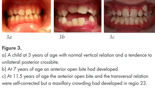Figure 4.  A child with unilateral posterior crossbite and anterior open bite  at 3 years of age (a) and at 7 years of age (b) self-correction had occurred.