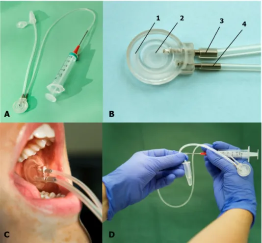 Figure 1. (A) Parotid saliva collection set up (cup, metal and silicone tubes, syringe, and cannula)